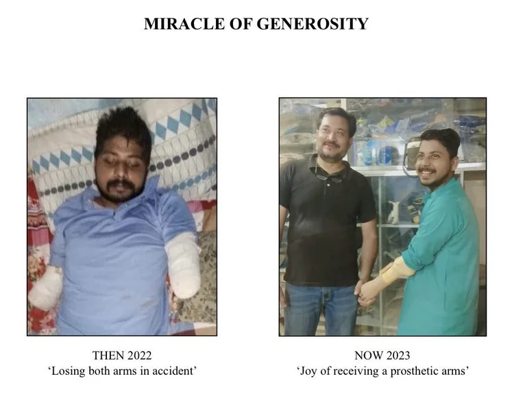 Sunil before and after receiving prosthetic arms.